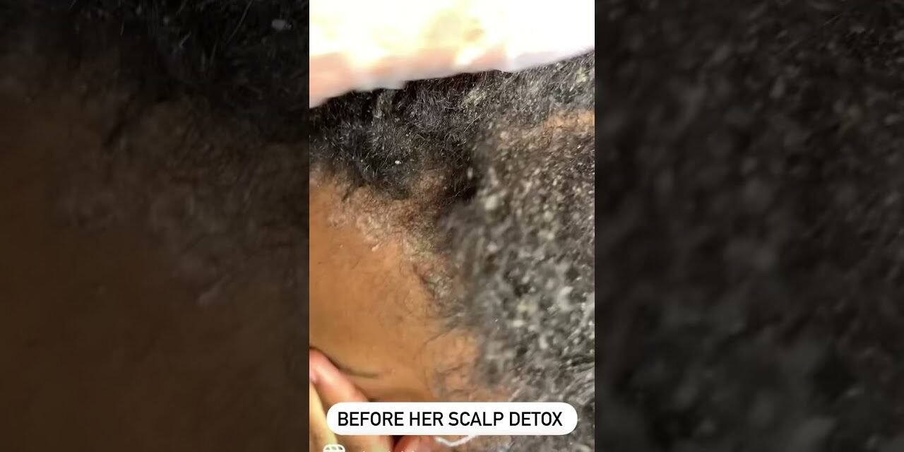 How to do a scalp detox